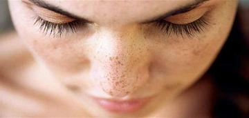 Cilt Yanığı Belirtileri ve Tedavisi Cilt Yanığı Belirtileri ve Tedavisi