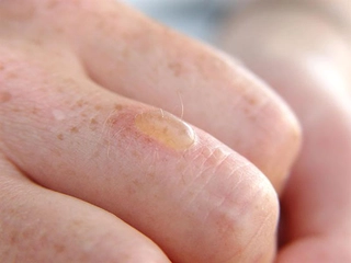 Yanık Sonrası Su Toplaması Yanık Sonrası Su Toplaması